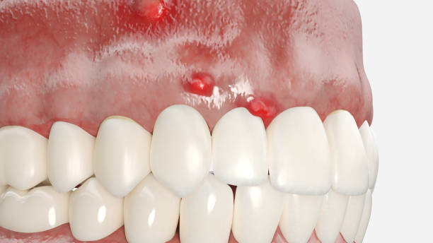 Dental abscess, illustration.