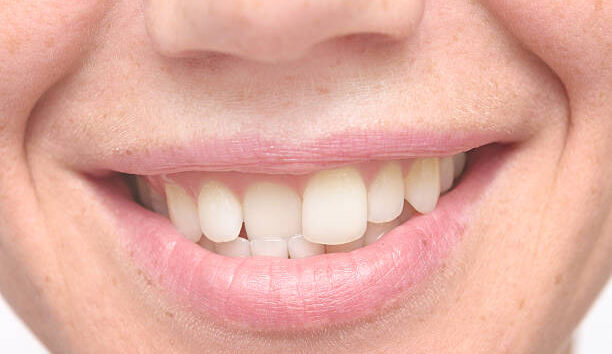 close up shot of crooked teeth