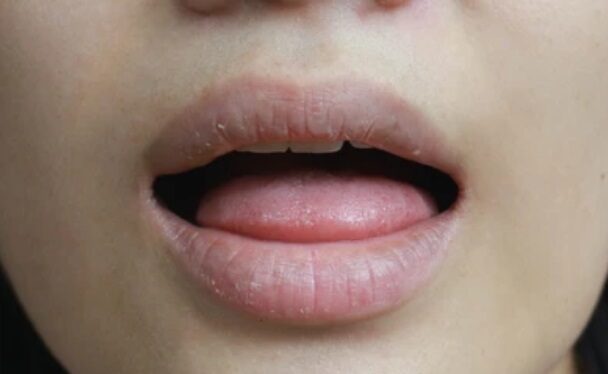 dry mouth