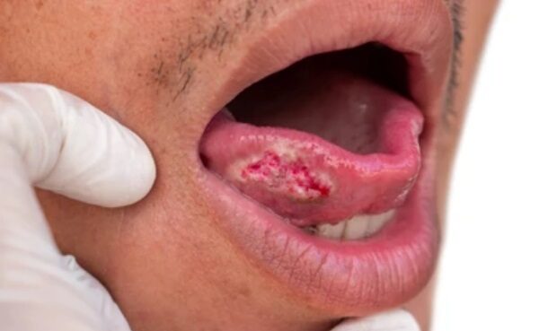 oral cancer