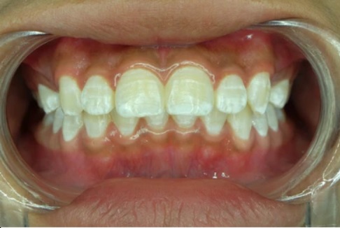 Dental Fluorosis​ pic
