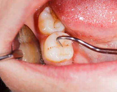cavity 2