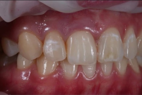 dental flurosis pic 2