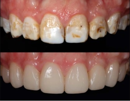 dental flurosis pic 3