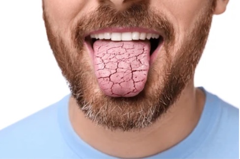 dry mouth man