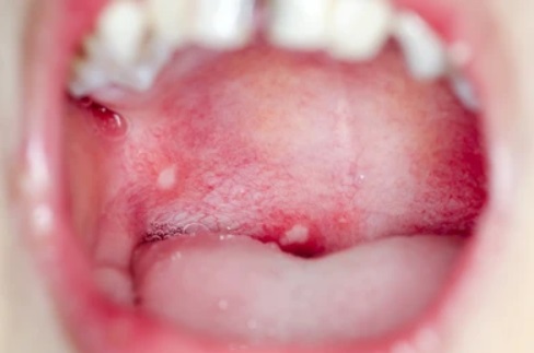 mouth ulcer pic